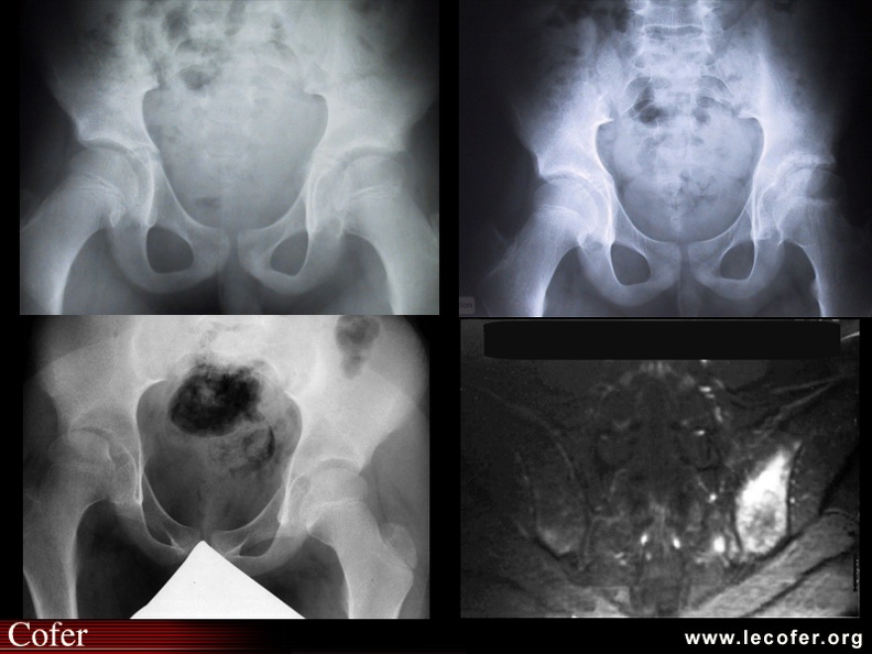 Spondylarthropathie juvénile, SPA, pédiatrie, spondylarthrite