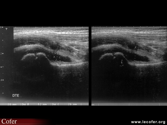 Arthrite aiguë bénigne de hanche : échographie