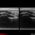 Arthrite aiguë bénigne de hanche : échographie