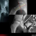 Pathologie de hanche : épiphysiolyse et maladie de Legg-Calvé-Perthes