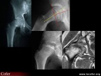 Pathologie de hanche : épiphysiolyse et maladie de Legg-Calvé-Perthes