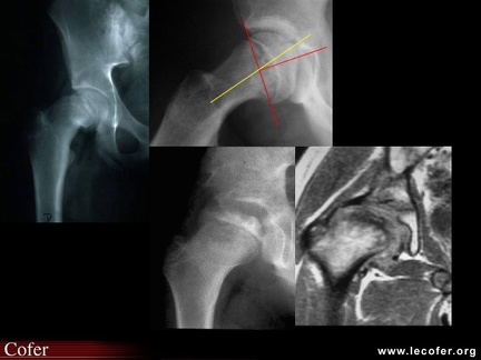 Pathologie de hanche : épiphysiolyse et maladie de Legg-Calvé-Perthes