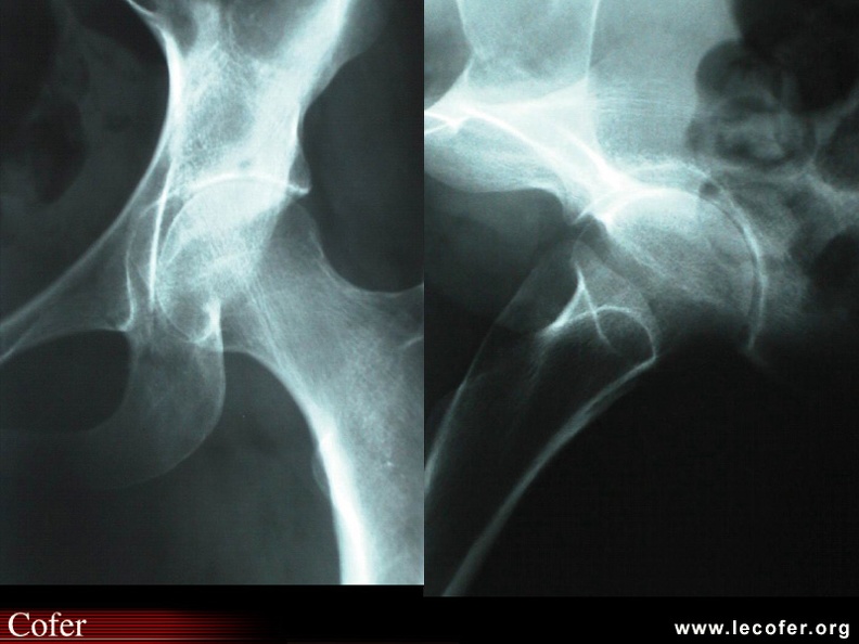 Coxite érosive gauche dans le cadre d'une MSA (clichés de face et de profil). L'aspect radiologique est aspécifique. SA007.jpg