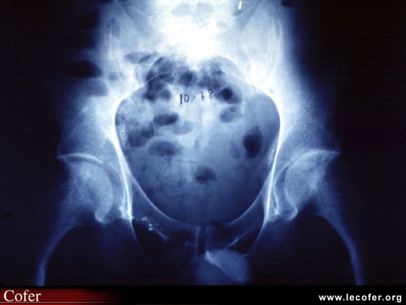 Coxite érosive gauche dans le cadre d'une MSA. L'aspect radiologique est aspécifique. SA010.jpg