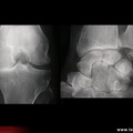 Chondrocalcinose et hyperparathyroïdie