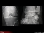 Chondrocalcinose et hyperparathyroïdie