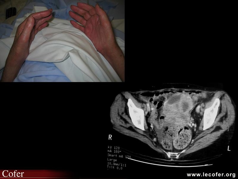 Fasciite palmaire liée à un cancer ovarien. 000000000249.jpg