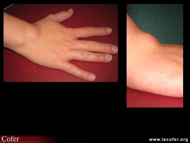 Kyste synovial du poignet - 000000000375.jpg 000000000375.jpg