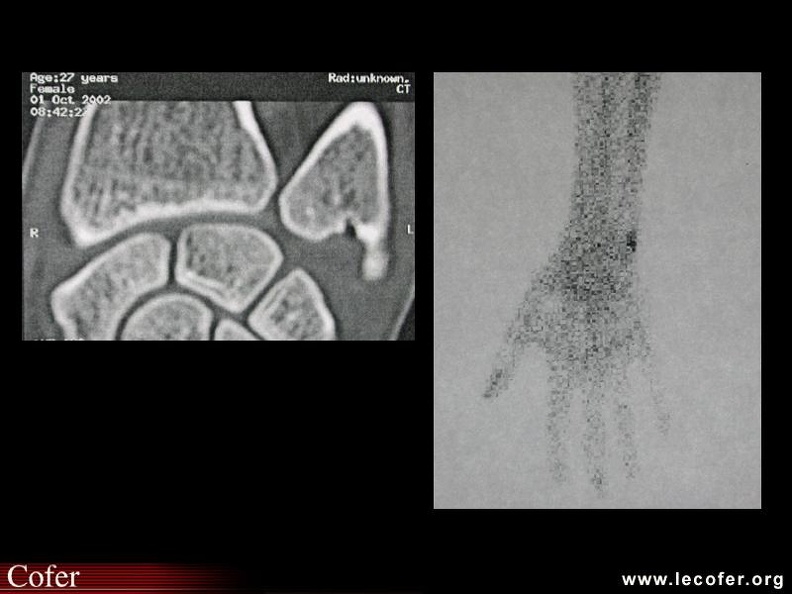 Scanner et scintigraphie osseuse. 000000000402.jpg