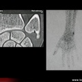 Ostéome ostéoïde : cubitus