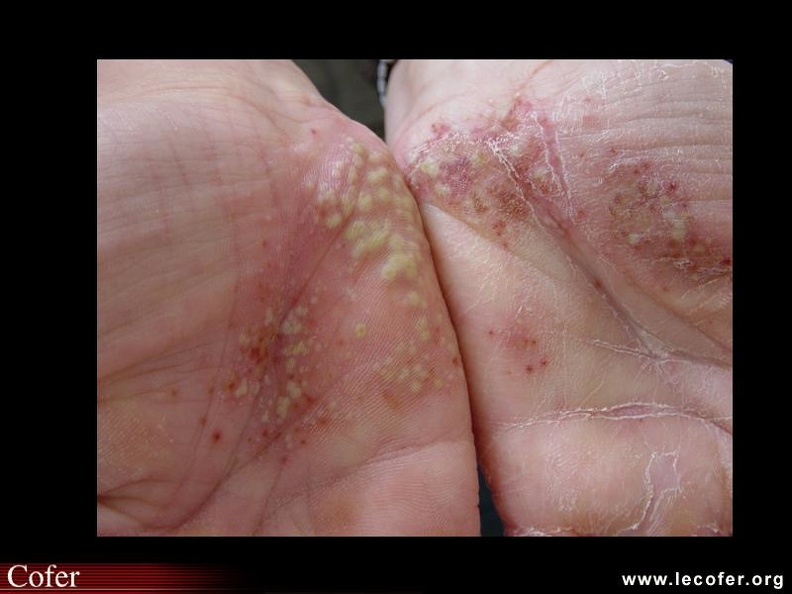 Pustulose palmo-plantaire. 000000000504s.jpg