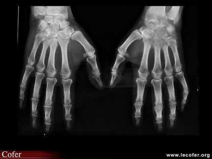 Arthrite septique du poignet