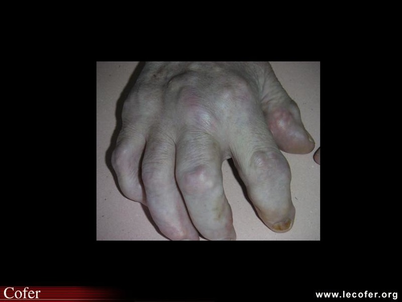Multiples tophi visibles sur les mains, atteinte des IPP et IPD déformation ostéo-articulaire. Lésions radiologiques d'arthropathie goutteuse : associant lésions osseuses et articulaires ; pincement articulaire métatarsophalangien, prédominant au 1er interligne ; érosions des surfaces articulaires ; gonflement des parties molles ; aspect de tophus : hyperdensité avec gonflement partie molle (interligne scaphoïde-cunéiforme droit). 000000000644s.jpg