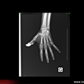 Calcinose sous-cutanée, sclérodermie, atteinte articulaire dans la sclérodermie : CREST syndrome