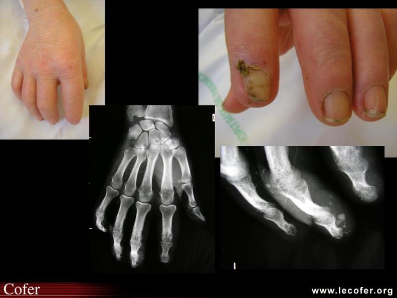 Sclérodermie systémique, avec aspect boudiné des doigts, nécrose ischémique péri-unguéale et calcinose sous-cutanée sur la radiographie. 000000000724s.jpg