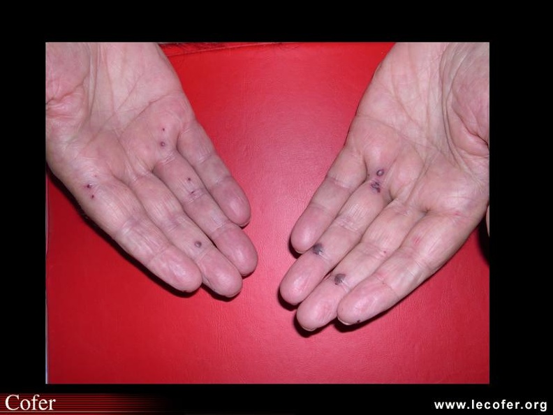 Maladie de Wegener, purpura inflammatoire nécrotique. 000000000759s.jpg
