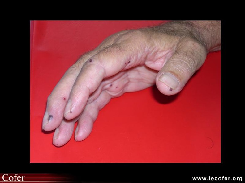 Maladie de Wegener : purpura inflammatoire nécrotique. 000000000760s.jpg