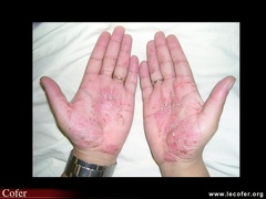 Psoriasis pustuleux palmaire