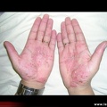 Psoriasis pustuleux palmaire