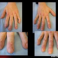 Cutis laxa : aspect macroscopique des mains