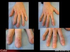 Cutis laxa : aspect macroscopique des mains