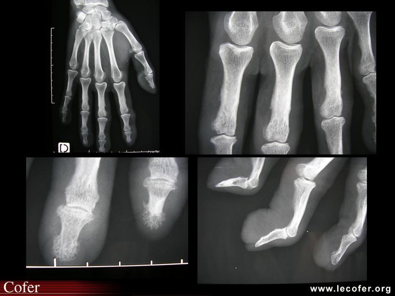 Cutis laxa : aspect radiologique des mains. 000000000823s.jpg