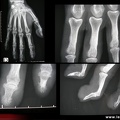 Cutis laxa : aspect radiologique des mains