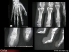 Cutis laxa : aspect radiologique des mains