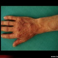 Polyarthrite rhumatoïde, ténosynovite des extenseurs des doigts dans la polyarthrite rhumatoïde