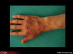 Polyarthrite rhumatoïde, ténosynovite des extenseurs des doigts dans la polyarthrite rhumatoïde