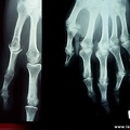 Rhumatisme psoriasique : radiographies, radios