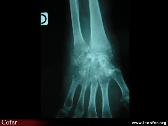 Arthrite septique : radiographies, radios