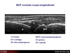 Échographie, articulation métacarpo-phalangienne normale, MCP