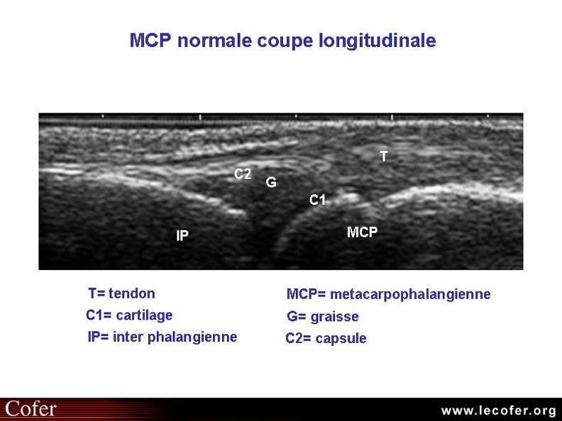 Articulation MétaCarpo-Phalangienne (MCP) normale. 010301001.jpg