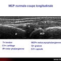 Échographie, articulation métacarpo-phalangienne normale, MCP