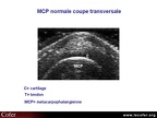 Échographie, articulation métacarpo-phalangienne normale, MCP