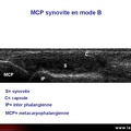 Synovite inflammatoire, échographie