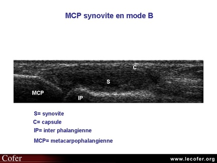 Synovite inflammatoire, échographie