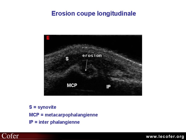 Érosion  osseuse, échographie