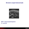 Érosion osseuse, échographie