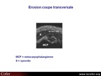 Érosion osseuse, échographie