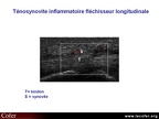 Ténosynovite inflammatoire, échographie