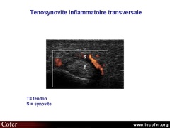 Ténosynovite inflammatoire, échographie