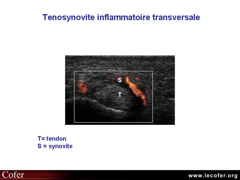 Ténosynovite inflammatoire, échographie