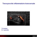 Ténosynovite inflammatoire, échographie