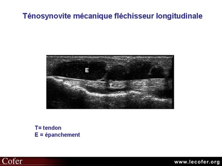 Ténosynovite, échographie