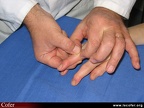 Polyarthrite rhumatoïde, PR débutante, PR : détection d’une synovite (épanchement) d’une IPP : palpation à 4 doigts