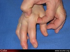 Polyarthrite rhumatoïde, PR débutante, PR : détection d’une synovite (épanchement) d’une MCP à 2 doigts