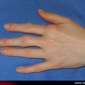 Polyarthrite rhumatoïde, PR débutante, PR ; reconnaître l’atteinte inflammatoire précoce de la main ; aspect d’IPP en fuseau