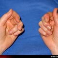 Polyarthrite rhumatoïde, PR débutante, PR ; reconnaître l’atteinte inflammatoire précoce de la main ; face ventrale de la main